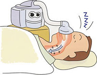 CPAP（シーパップ：経鼻的続陽圧呼吸法）